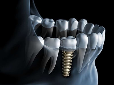 Implant