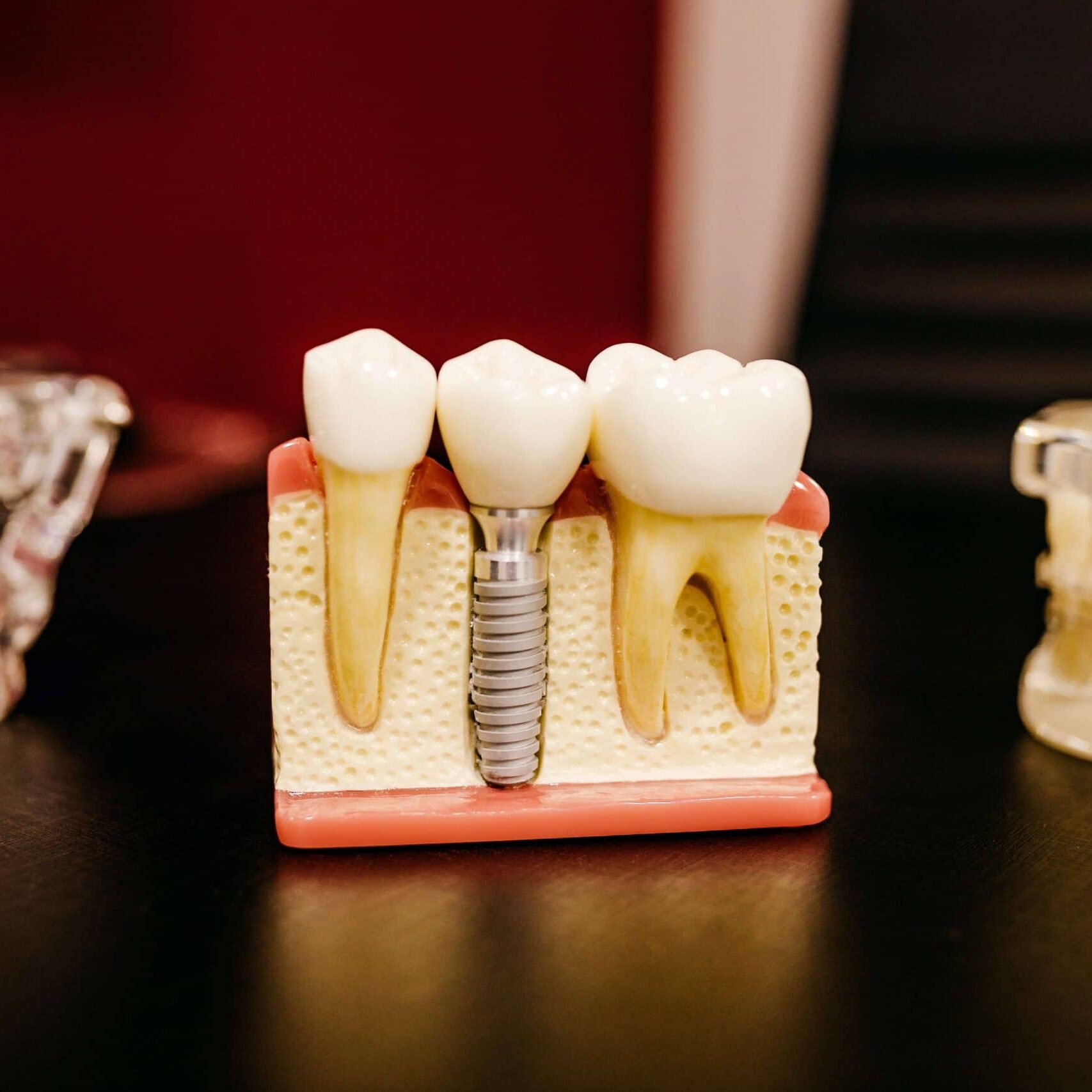 Dental Implants Dental Implants