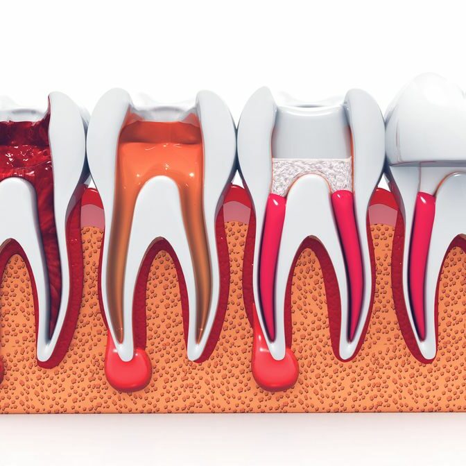 What is a Root Canal Treatment? What is a Root Canal Treatment?
